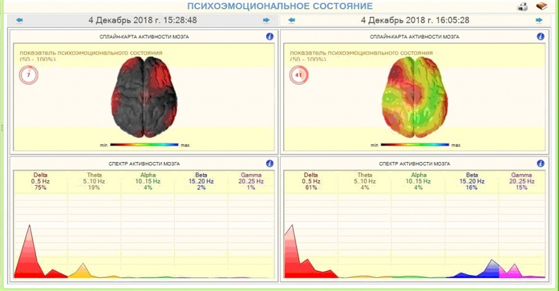 Примеры прослушивания ГАРМОНИК ЭРА: психоэмоциональное состояние